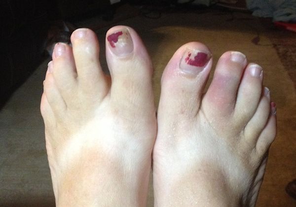Injured Toes