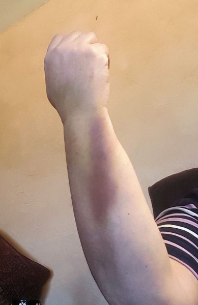 Bruised Arm
